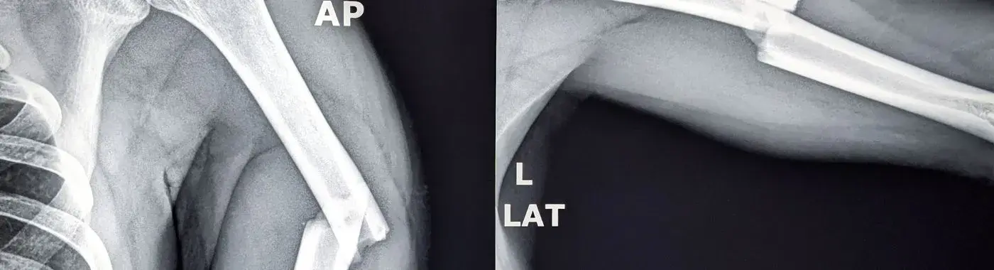 Compound Fracture - Causes, Symptoms, Diagnosis, Treatment, and Prevention