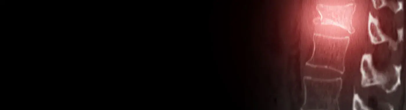 Compression Fractures - Causes, Symptoms, Diagnosis, Treatment, and Prevention