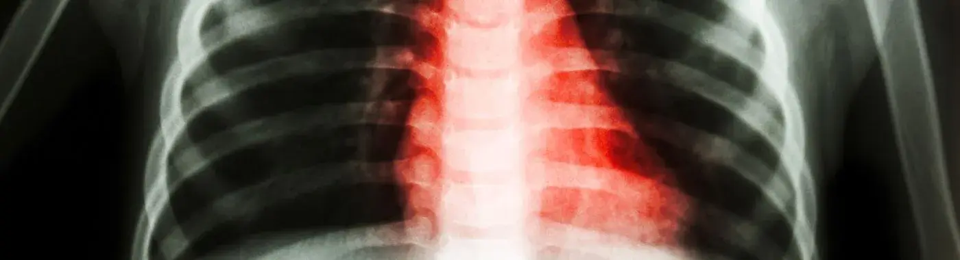 Congenital Heart Disease