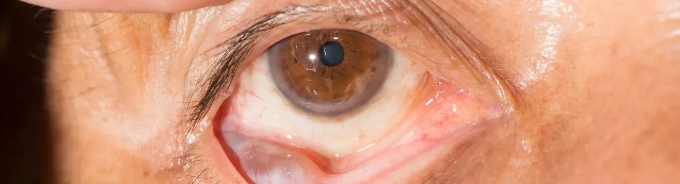 Conjunctival Cyst - Causes, Symptoms, Diagnosis, Treatment, and Prevention