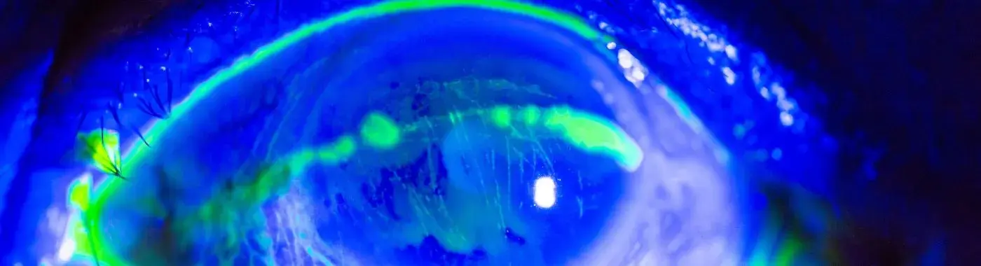 Corneal Abrasion - Causes, Symptoms, Diagnosis, Treatment, and Prevention