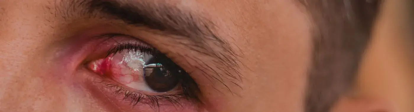 Corneal Hydrops - Causes, Symptoms, Diagnosis, Treatment, and Prevention