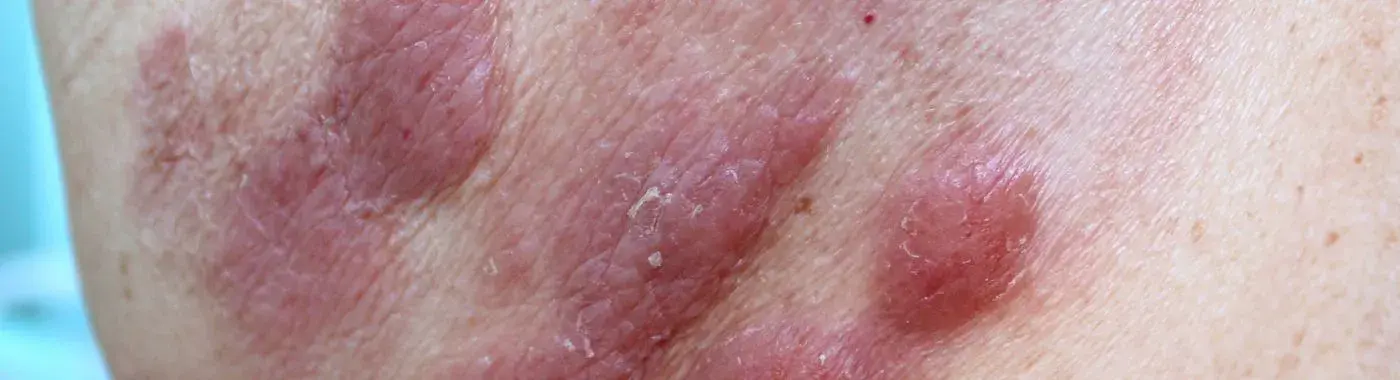 Cutaneous T-Cell Lymphoma - Early Signs, Risk Factors, Diagnosis, and Treatment Explained