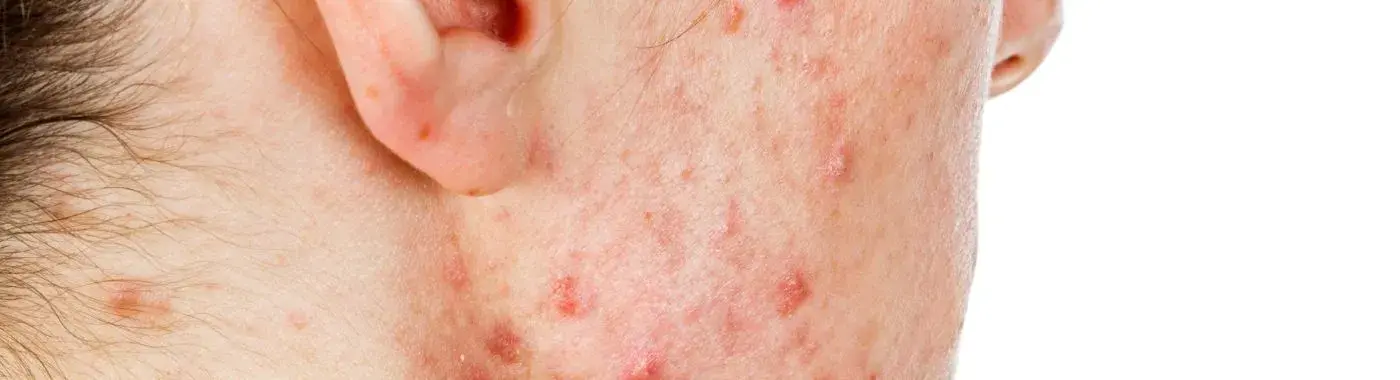 Cystic Acne - Causes, Symptoms, Diagnosis, Treatment, and Prevention