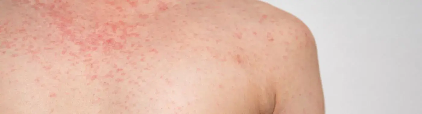 Cytomegalovirus - Causes, Symptoms, Diagnosis, Treatment, and Prevention