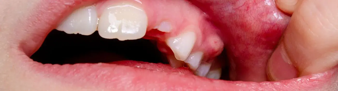 Dental abscess