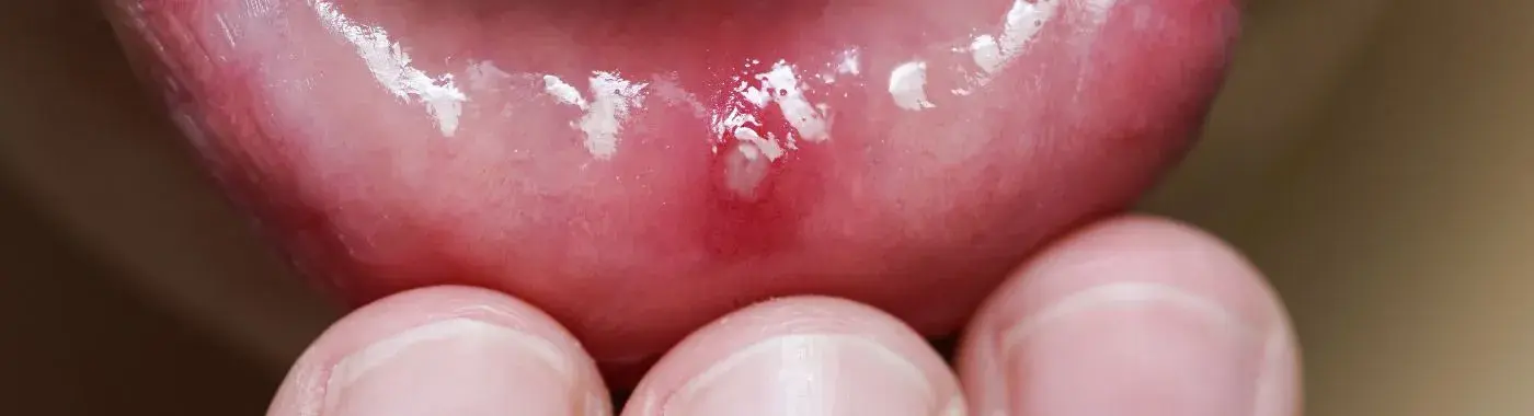 Denture Stomatitis - Causes, Symptoms, Diagnosis, Treatment, and Prevention