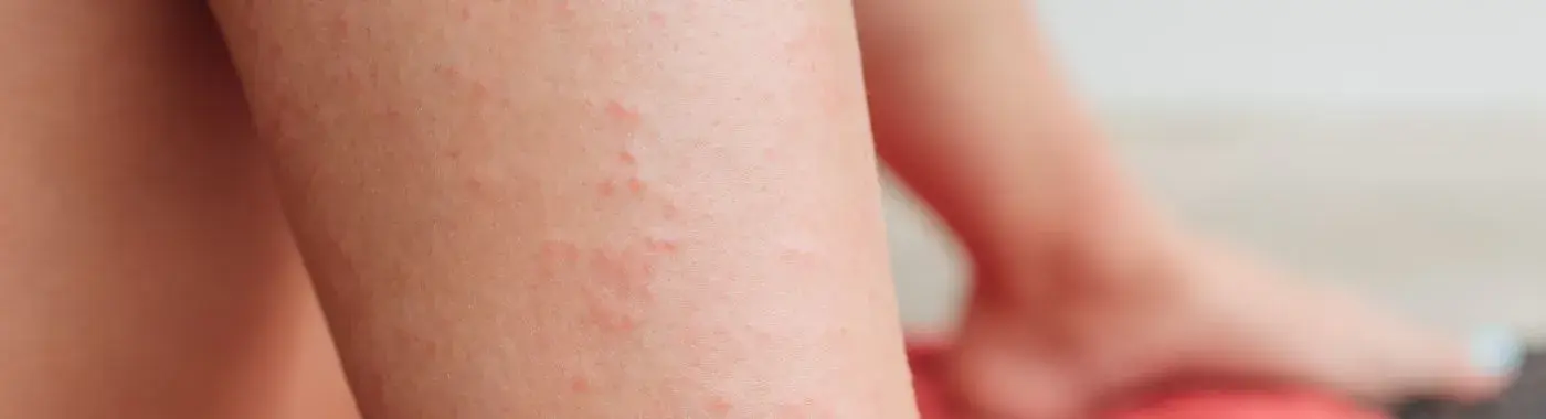 Dermatitis Herpetiformis - Causes, Symptoms, Diagnosis, Treatment, and Prevention
