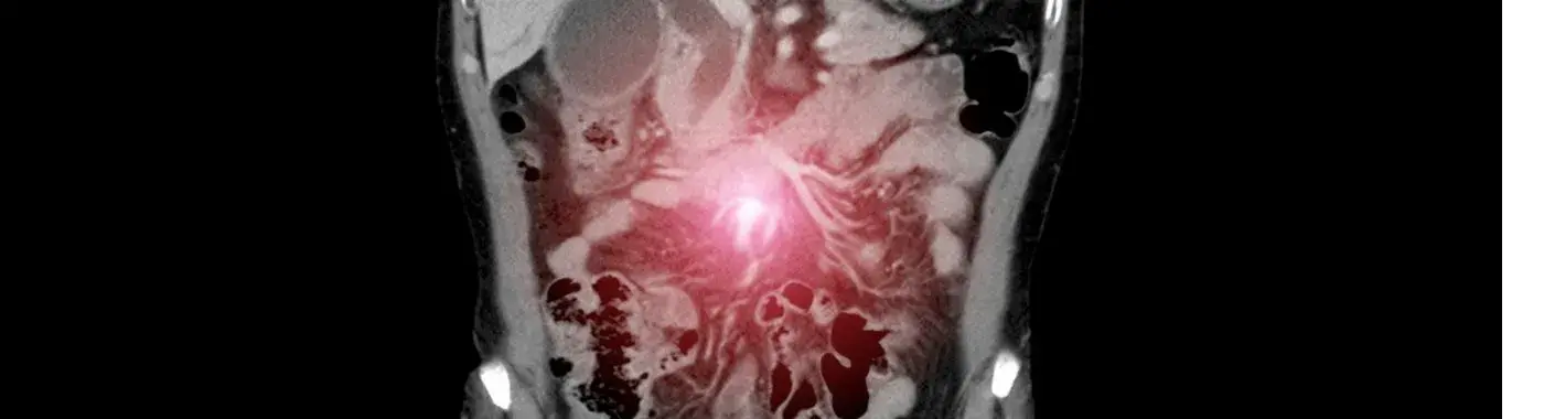 Desmoplastic Small Round Cell Tumors - Early Signs, Risk Factors, Diagnosis, and Treatment Explained