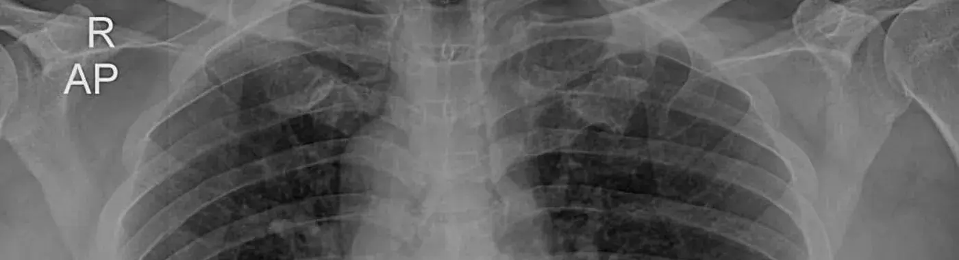 Dextrocardia Situs Inversus - Causes, Symptoms, Diagnosis, Treatment, and Prevention