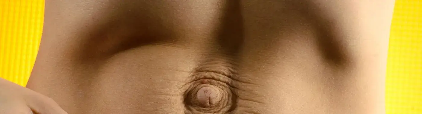 Diastasis Recti - Causes, Symptoms, Diagnosis, Treatment, and Prevention