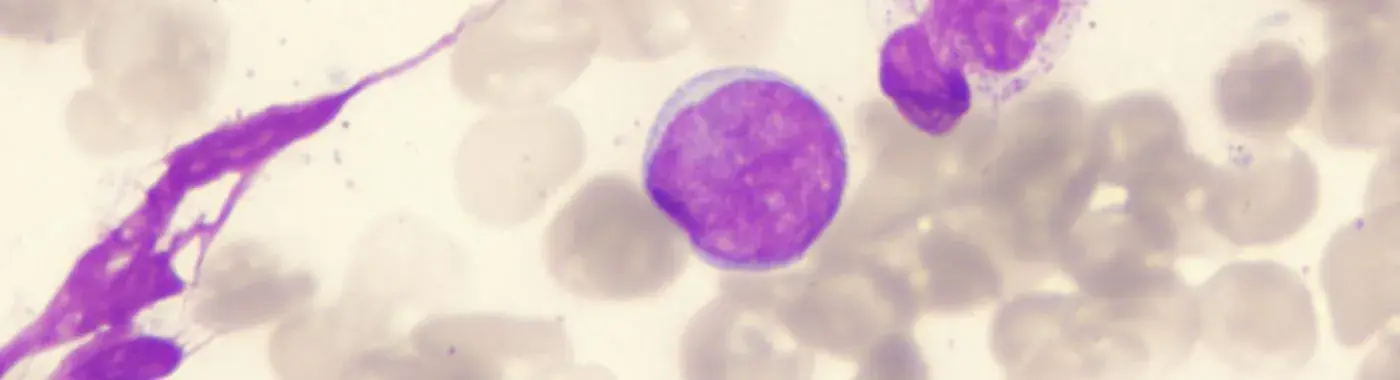 Diffuse Large B Cell Lymphoma - Causes, Symptoms, Diagnosis, Treatment, and Prevention