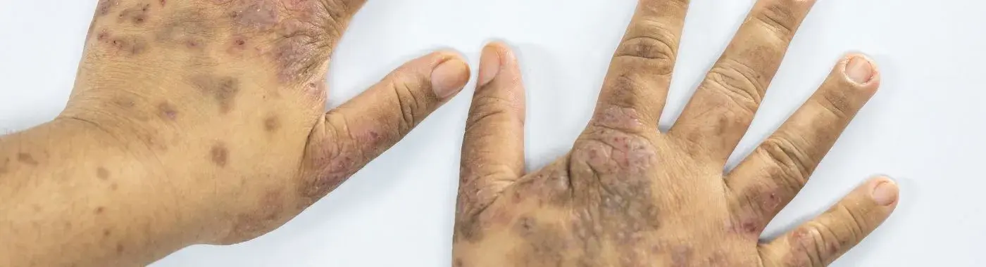 Discoid Lupus - Causes, Symptoms, Diagnosis, Treatment, and Prevention