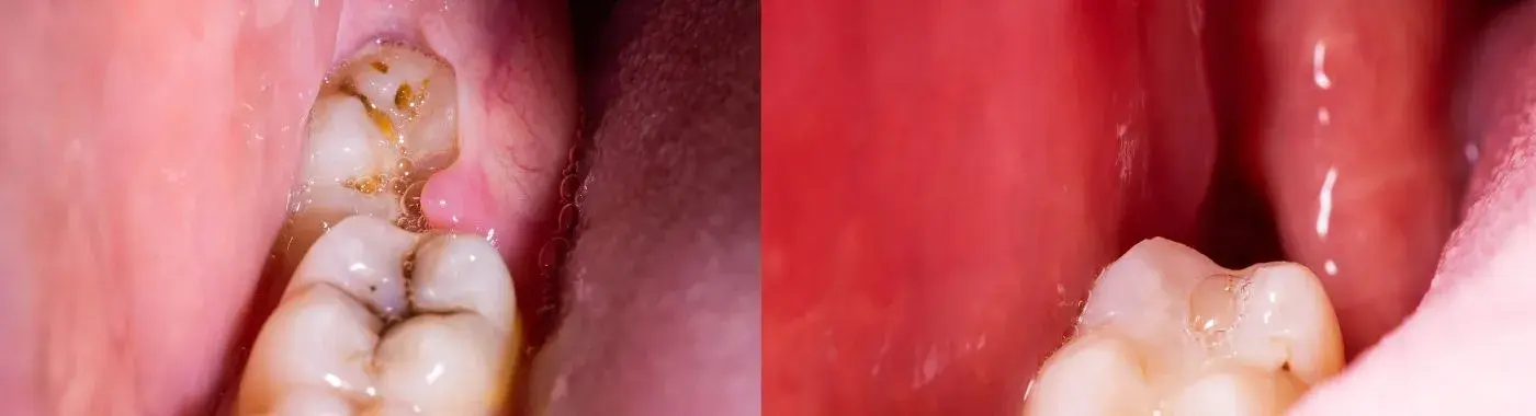 Dry Socket - Causes, Symptoms, Diagnosis, Treatment, and Prevention