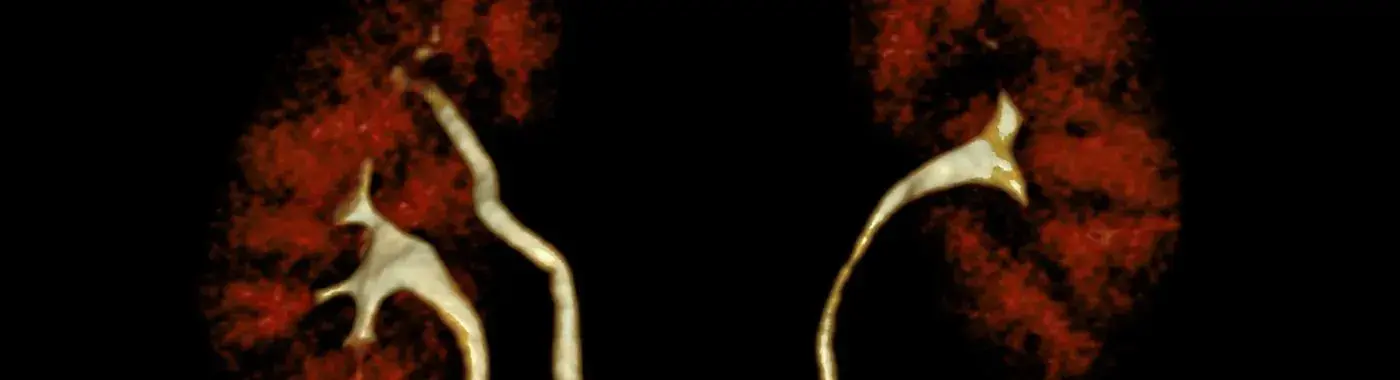 Duplex Kidney - Causes, Symptoms, Diagnosis, Treatment, and Prevention