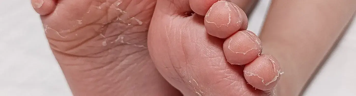 Dyshidrosis - Causes, Symptoms, Diagnosis, Treatment, and Prevention