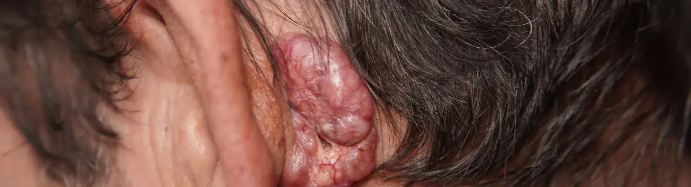 Ear Tumors - Causes, Symptoms, Diagnosis, Treatment, and Prevention