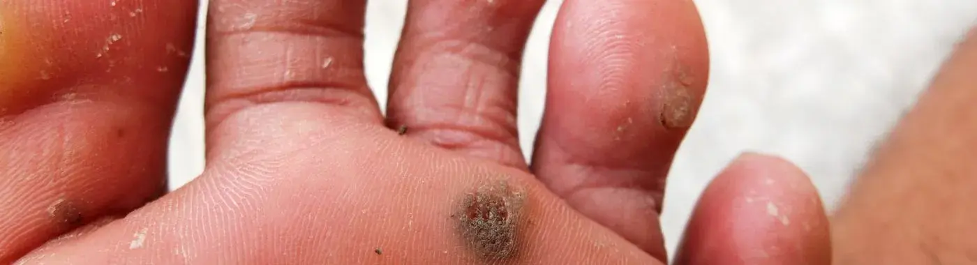 Eosinophilic Fasciitis - Causes, Symptoms, Diagnosis, Treatment, and Prevention