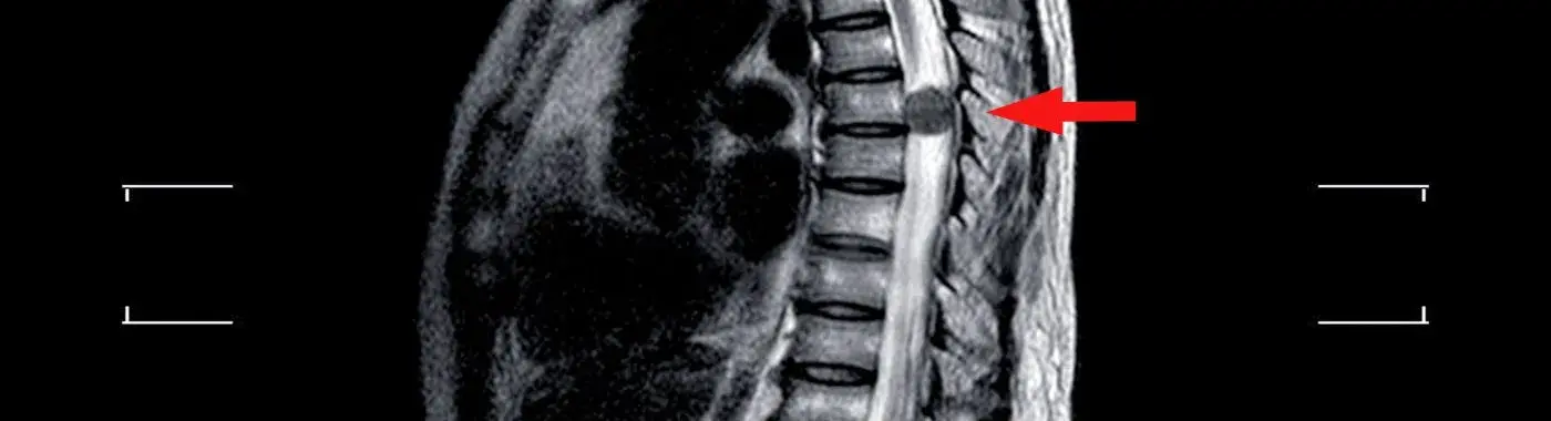 Extramedullary Tumors - Early Signs, Risk Factors, Diagnosis, and Treatment Explained