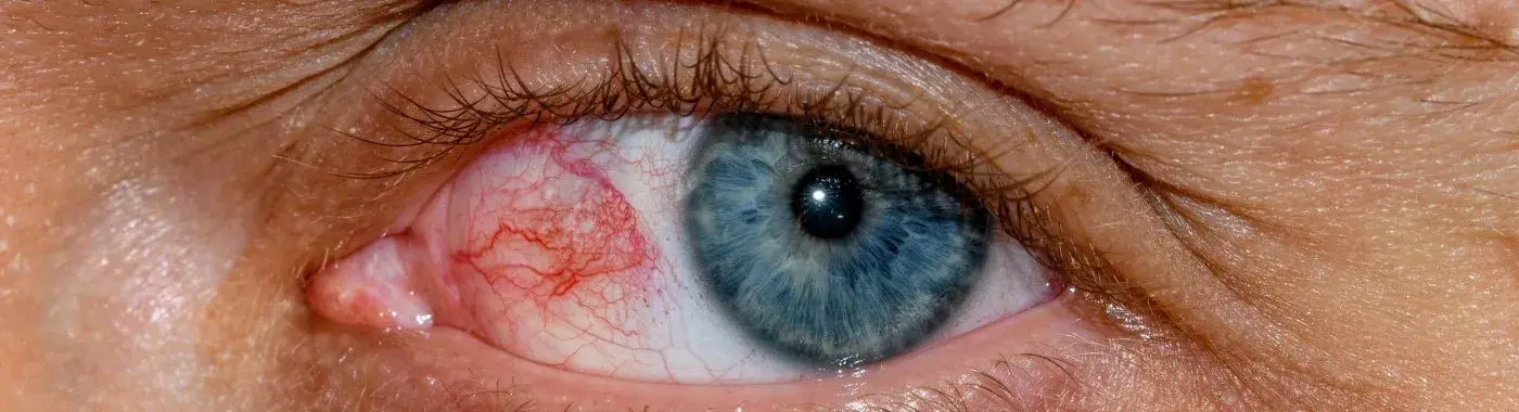 Eye Stroke - Causes, Symptoms, Diagnosis, Treatment, and Prevention