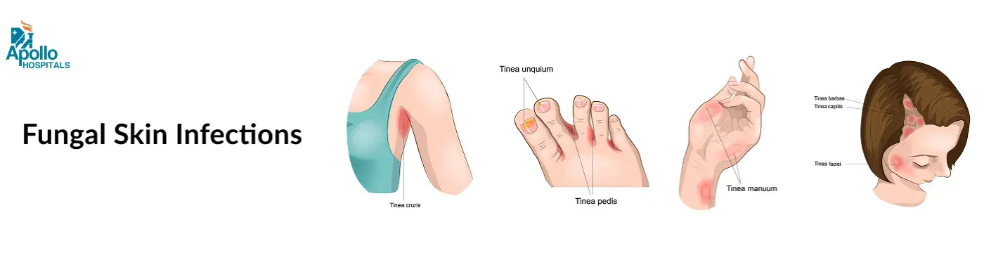 Fungal Skin Infections