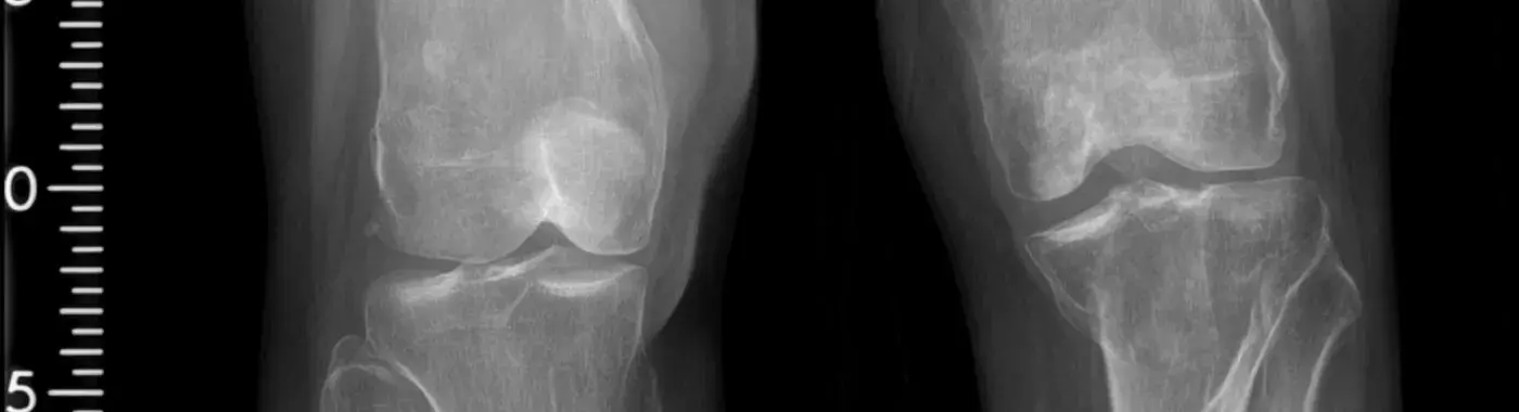 Heterotopic Ossification - Causes, Symptoms, Diagnosis, Treatment, and Prevention