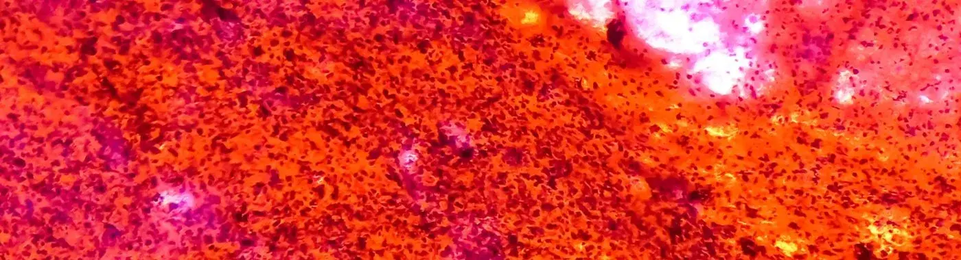 Hilar Cholangiocarcinoma - Causes, Symptoms, Diagnosis, Treatment, and Prevention