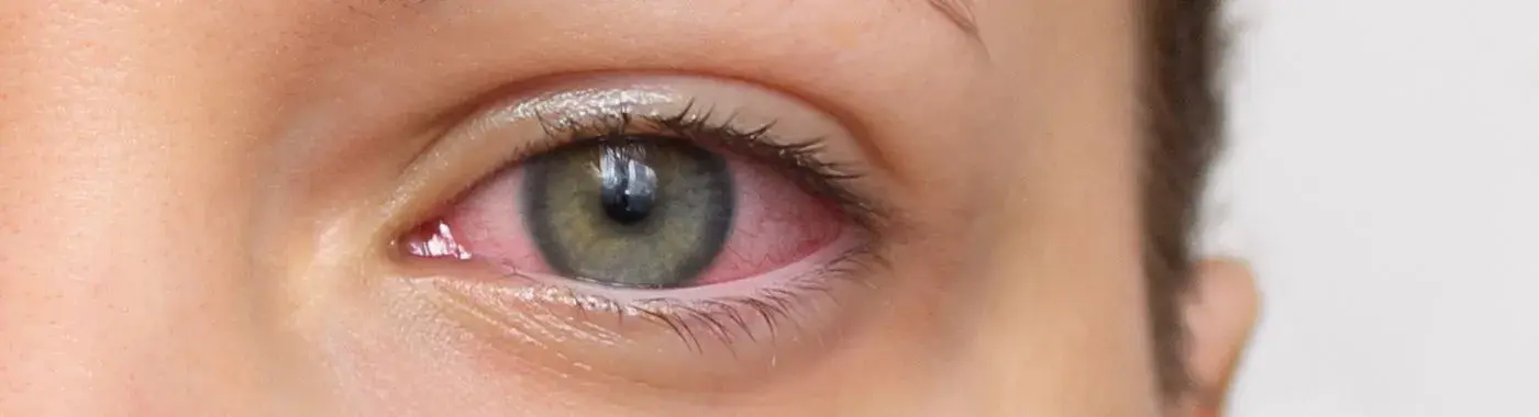 Hyphema - Causes, Symptoms, Diagnosis, Treatment, and Prevention