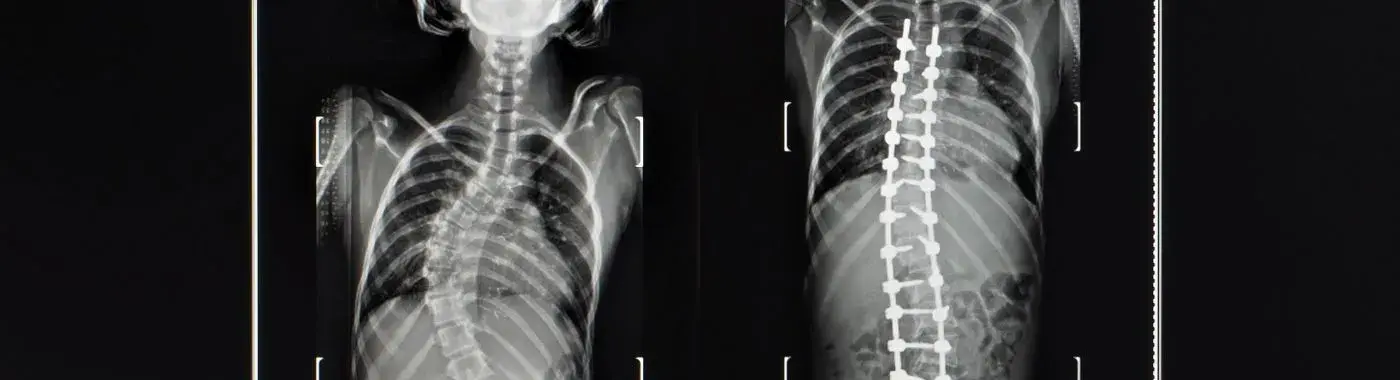 Idiopathic Scoliosis - Causes, Symptoms, Diagnosis, Treatment, and Prevention