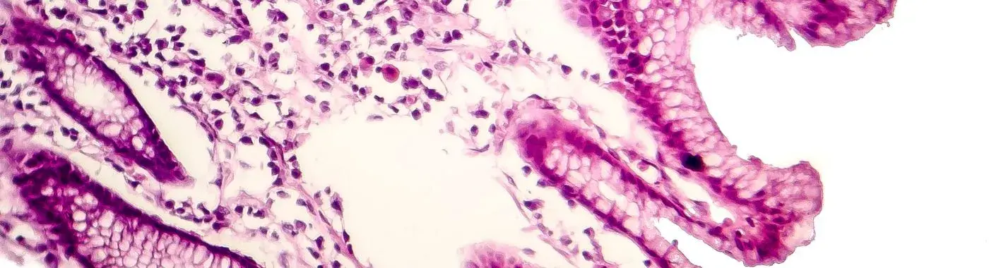 Intestinal Metaplasia - Causes, Symptoms, Diagnosis, Treatment, and Prevention