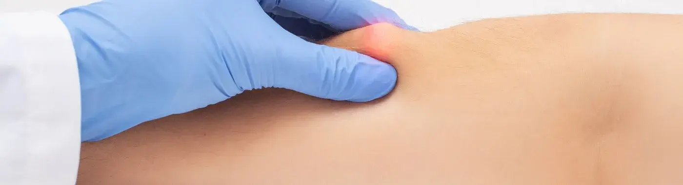 Intramuscular Lipoma - Causes, Symptoms, Diagnosis, Treatment, and Prevention