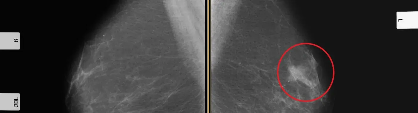 Invasive ductal carcinoma - Early Signs, Risk Factors, Diagnosis, and Treatment Explained