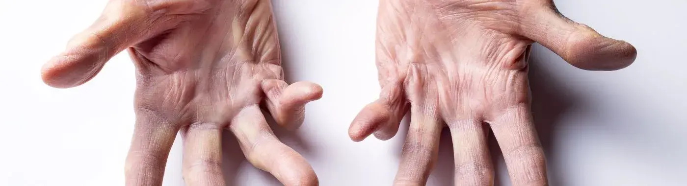 Mixed Connective Tissue Disease - Causes, Symptoms, Diagnosis, Treatment, and Prevention