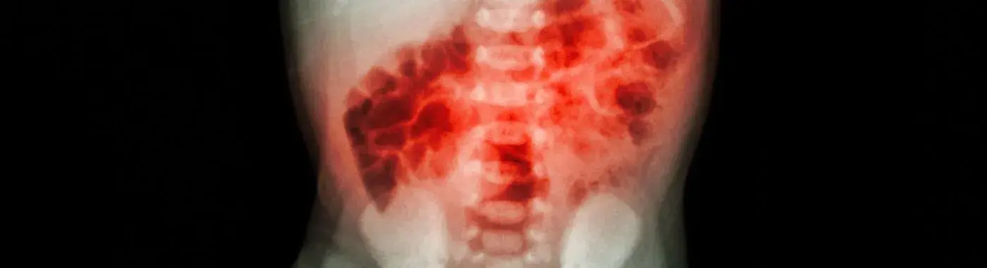 Necrotizing Enterocolitis - Causes, Symptoms, Diagnosis, Treatment, and Prevention