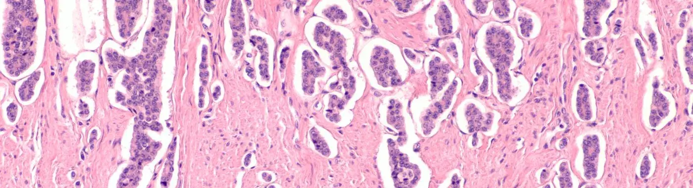 Neuroendocrine Tumors - Early Signs, Risk Factors, Diagnosis, and Treatment Explained