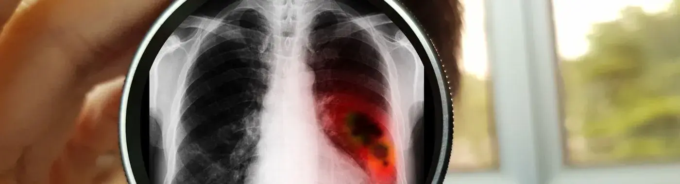 Nut Carcinoma - Causes, Symptoms, Diagnosis, Treatment, and Prevention