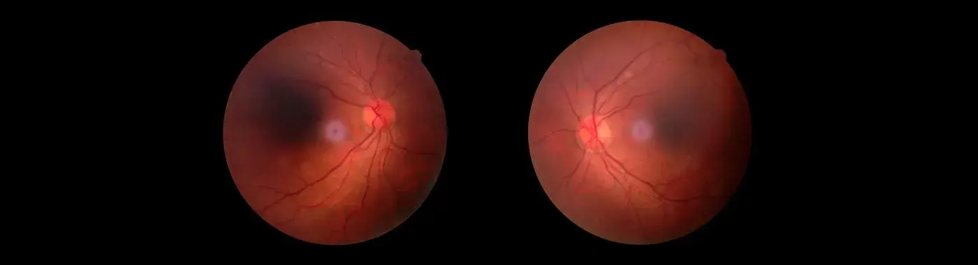 Ocular Ischemic Syndrome - Causes, Symptoms, Diagnosis, Treatment, and Prevention