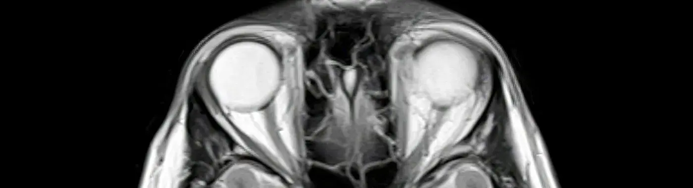 Optic Disc Drusen - Causes, Symptoms, Diagnosis, Treatment, and Prevention