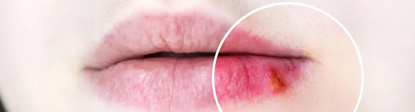 Oral Herpes - Causes, Symptoms, Diagnosis, Treatment, and Prevention