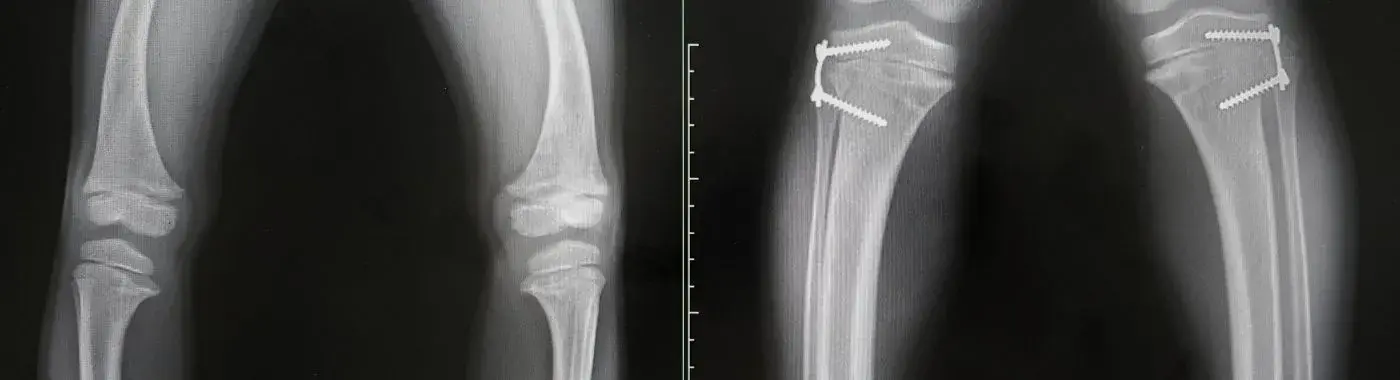 Osteomalacia - Causes, Symptoms, Diagnosis, Treatment, and Prevention