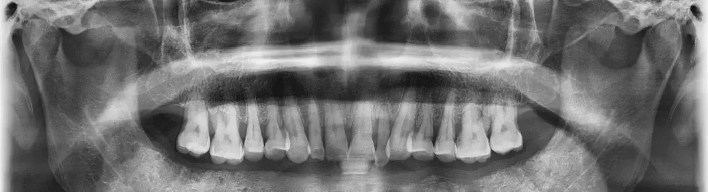 Osteoradionecrosis - Causes, Symptoms, Diagnosis, Treatment, and Prevention