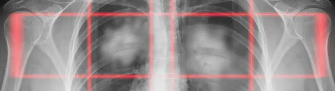 Pancoast Tumor - Causes, Symptoms, Diagnosis, Treatment, and Prevention