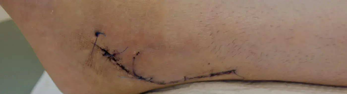 Peroneal Nerve Injury - Causes, Symptoms, Diagnosis, Treatment, and Prevention