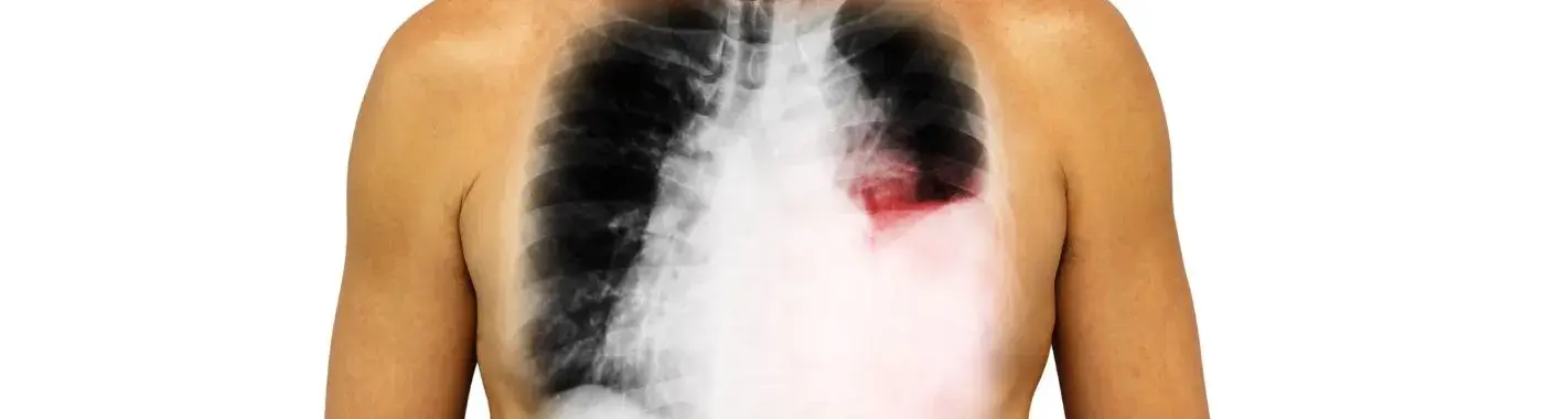 Pleural Effusion - Causes, Symptoms, Diagnosis, Treatment, and Prevention
