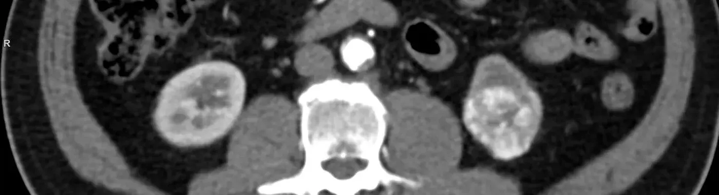 Renal Cell Cancer - Early Signs, Risk Factors, Diagnosis, and Treatment Explained