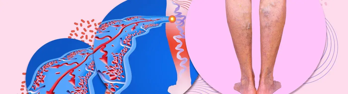 Smv Thrombosis - Causes, Symptoms, Diagnosis, Treatment, and Prevention
