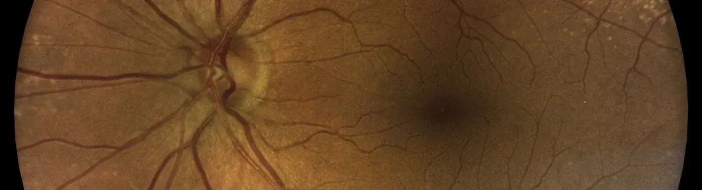 Terriens Marginal Degeneration - Causes, Symptoms, Diagnosis, Treatment, and Prevention