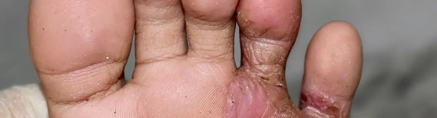 Tinea pedis - Causes, Symptoms, Diagnosis, Treatment, and Prevention