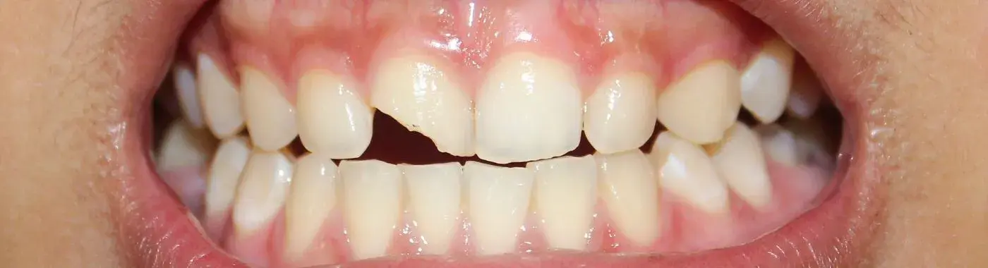 Tooth Luxation - Causes, Symptoms, Diagnosis, Treatment, and Prevention