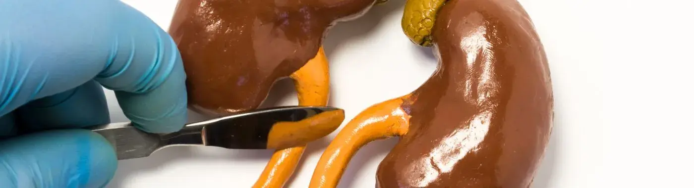 Ureteral Stones - Causes, Symptoms, Diagnosis, Treatment, and Prevention